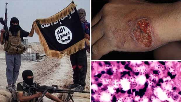 IŞİD teröristleri ölümcül Leyişmanyoz hastalığının pençesinde