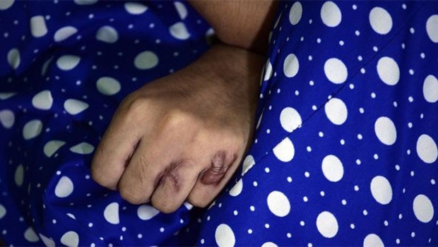 Hindistan'da bir kadına beşinci kez asit saldırısı